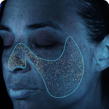 VISIA 7 à Lausanne - Analyse des porphyrines VISIA 7 à Lausanne - Analyse des porphyrines